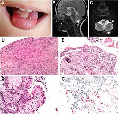 Clinical and Molecular Heterogeneity of RTEL1 Deficiency